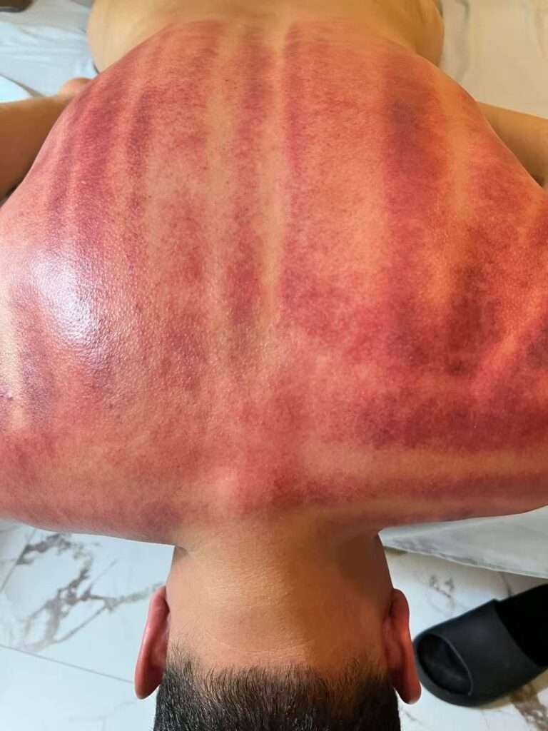 Sliding Cupping