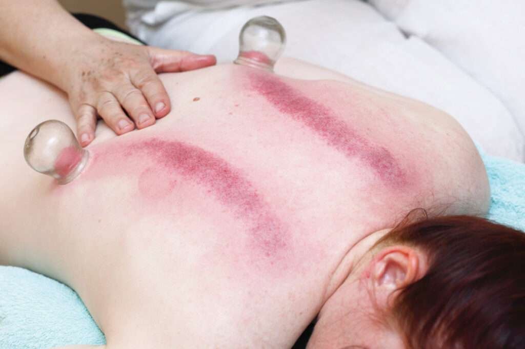 Sliding Cupping